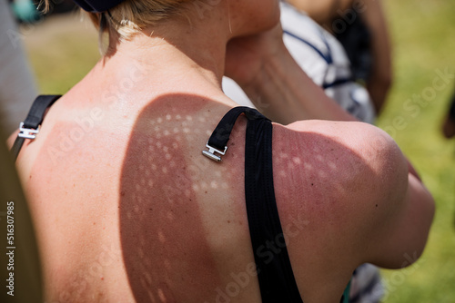 The girl's back was burned in the sun, tan marks from the bright sun, the bra clasp, the view from the back of a person on vacation, summer holidays at sea.