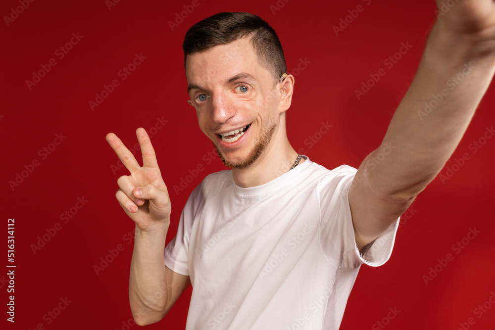Young man in white T-shirt with Treacher syndrome takes selfies, people with disabilities, genetic disease Young man in white T-shirt with Treacher syndrome takes selfies, people with disabilities, genetic disease