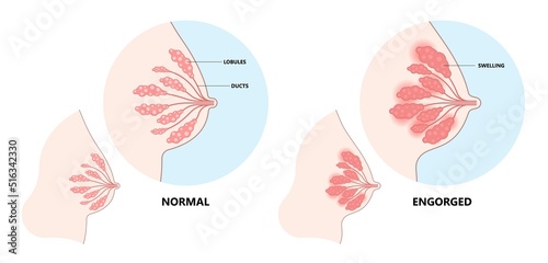 Inflamed of Breast with engorged blocked mass milk ducts swollen Breastfeed of pregnant