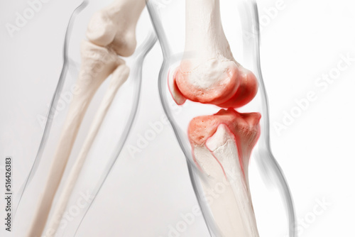 Knee meniscus pain, human legs, medically accurate representation of an arthritic knee joint