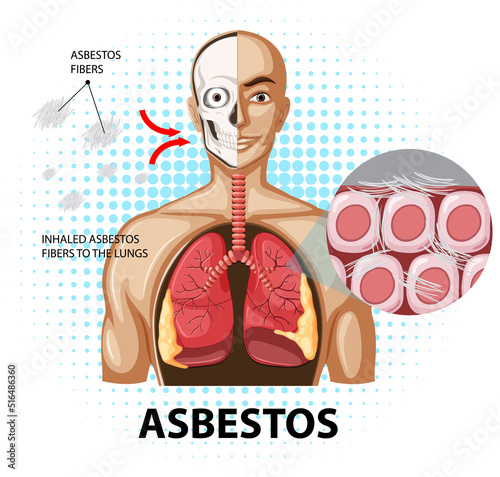 Diagram showing asbestosis in lungs