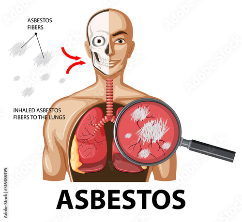 Diagram showing asbestosis in lungs