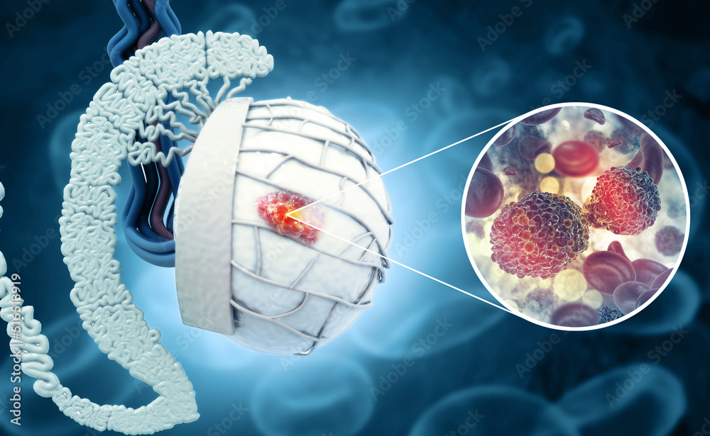 Obraz Testicular cancer. tumor develops in the testicles. male