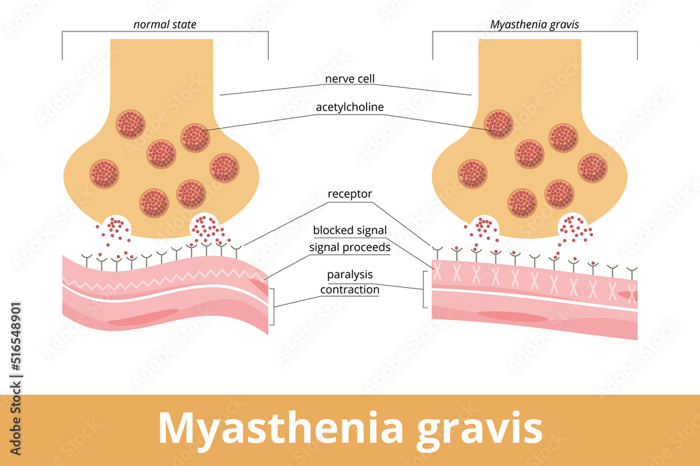 Myasthenia gravis. An autoimmune disease of the neuromuscular junction