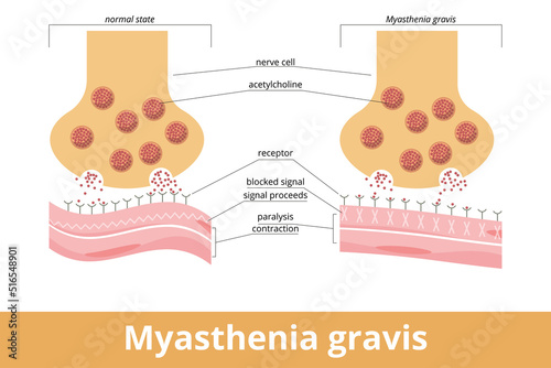 Myasthenia gravis. An autoimmune disease of the neuromuscular junction when antibodies block or destroy nicotinic acetylcholine receptors (AChR) at the junction between the nerve and muscle. photo
