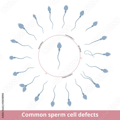 Common sperm cell defects. Visualization of common sperm cell defects, including head, tail, and midpiece pathologies, acromeless defect.