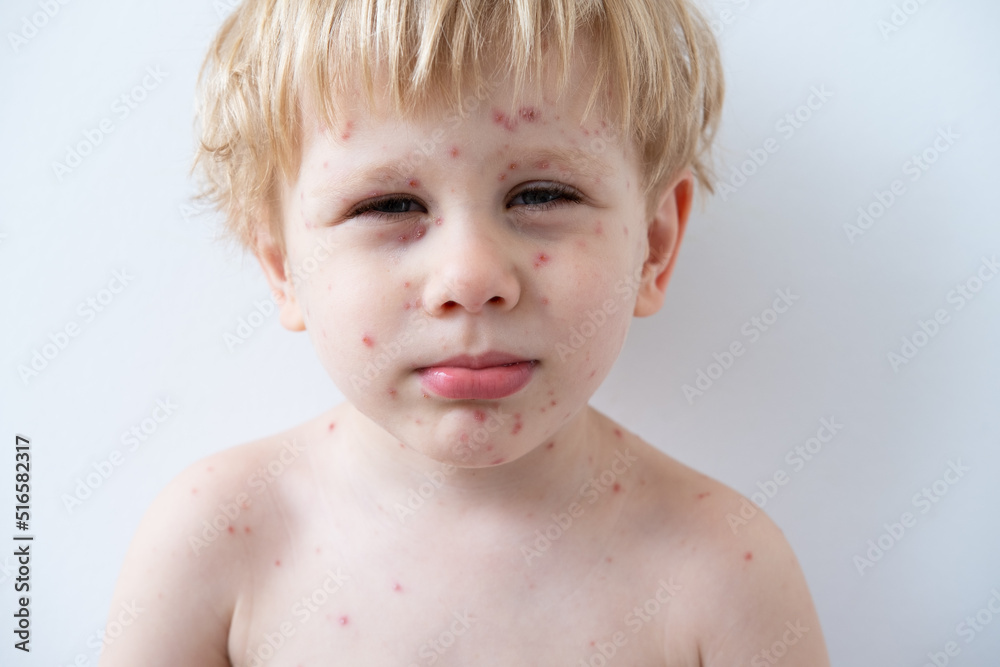 Chickenpox disease, portrait of blonde little boy with red rashes Chicken pox virus Chickenpox disease, portrait of blonde little boy with red rashes Chicken pox virus