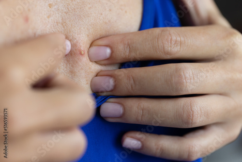 Woman try to take acne off from her chest. Closeup. Selective focus.
