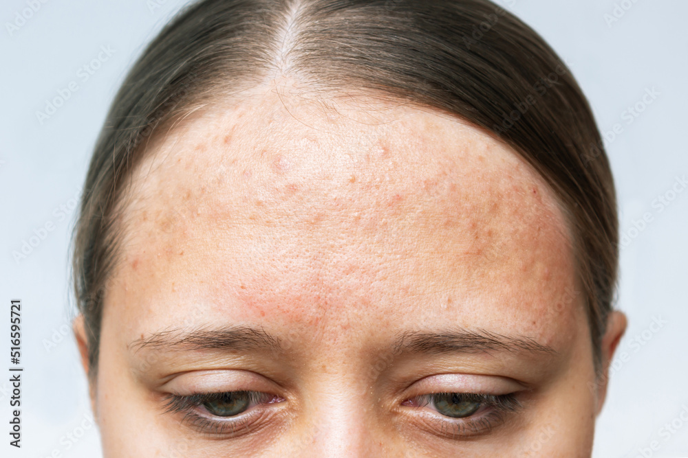 Close up of red allergic rash on a forehead. Cropped shot of young woman's face with acne problem. Allergies, pimples, hormonal changes. Problem skin, care and beauty concept. Dermatology, cosmetology