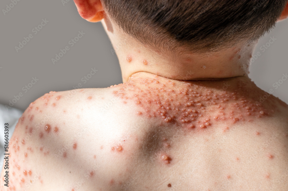 little baby boy with severe form of varicella,chickenpox virus.back view.lot of blisters on child body.nettle rash,urticaria, spread over the all body,most of them in shoulder,neck and hands area. little baby boy with severe form of varicella,chickenpox virus.back view.lot of blisters on child body.nettle rash,urticaria, spread over the all body,most of them in shoulder,neck and hands area.