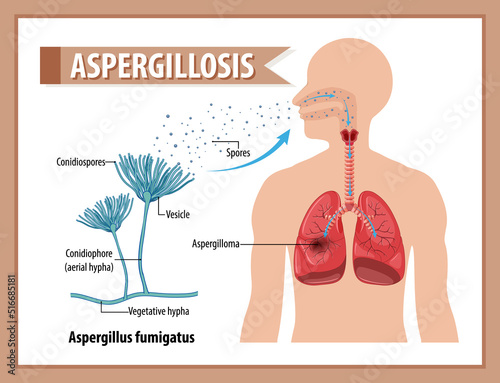 Diagram showing aspergillus infection