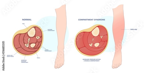 limb fascia edema disorder the fasciotomy surgery for swollen foot acute pain crush ischemia deep vein broken bone skin graft and nerve