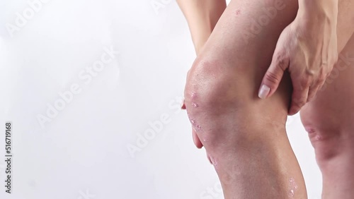 Psoriatic arthritis with skin psoriasis on a woman's knees. Inflammatory arthritis causing swelling, stiffness, redness, pain, and joint damage. Synovial fluid with psoriasis of the left knee.