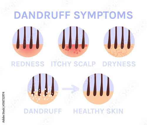 Dandruff and Icons. Zoom. Hair Problem. Symptoms. Dryness, Redness and Itchy Scalp. Closeup. Treatment. Before and After. Color Cartoon style. White background. Vector illustration for Medical Design.