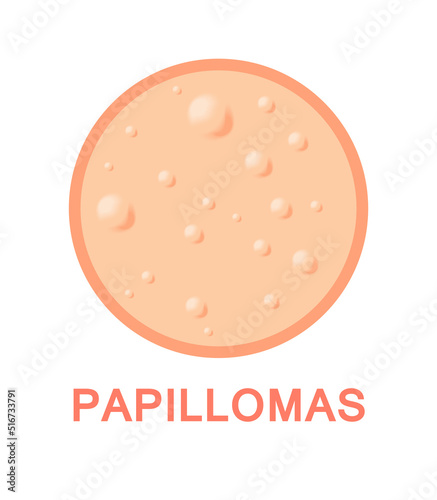 Papilloma Virus. Warts on Human Skin. Icon. Color Cartoon style. Closeup view. White background. Vector illustration for Medical and Educational Design.