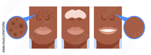 Black Dots on the Nose. Before and After. Nose Strips for Blackheads. Clear Skin and a Beautiful Female Smile on Face. Color Cartoon style. White background. Vector illustration for Beauty Design.