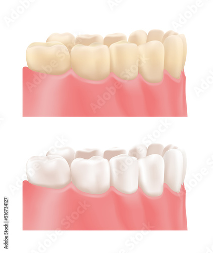 Yellow Dirty Teeth. Teeth Whitening. Treatment. Before and After. Clean Healthy Perfect Teeth. Side view. Color Realistic style. White background. Vector illustration for Medical and Dental Design.