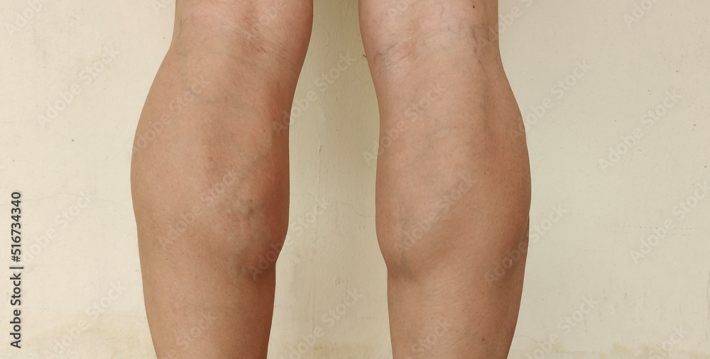 Portrait showing the calf muscles of runner, problem wrinkles and