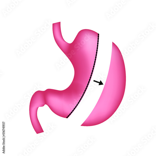 Longitudinal resection of the stomach. Treatment of obesity with surgery. Vector illustration