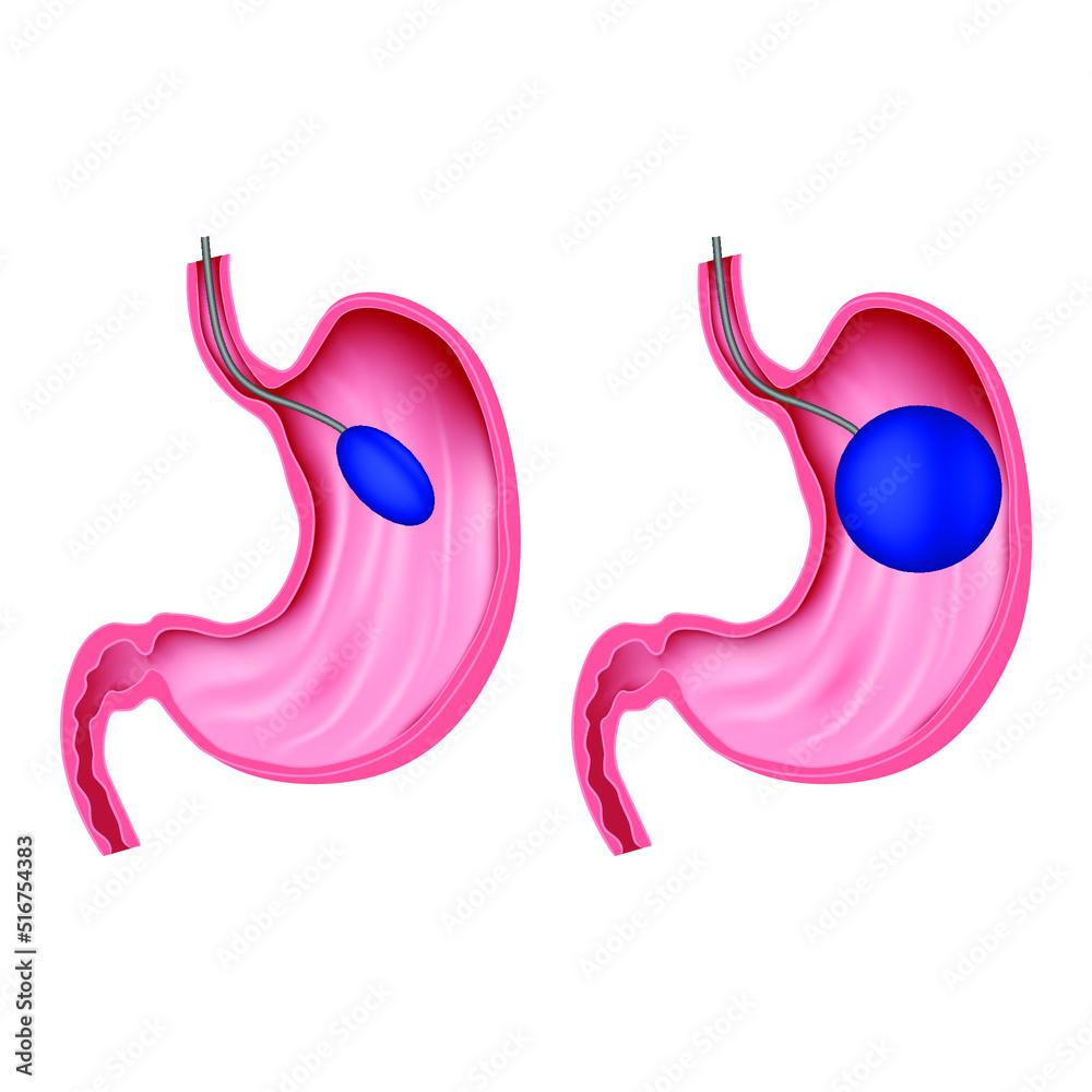 Installation of an intragastric balloon. Weight loss procedure. Anatomy of the digestive organs. Medical poster. Vector illustration Installation of an intragastric balloon. Weight loss procedure. Anatomy of the digestive organs. Medical poster. Vector illustration