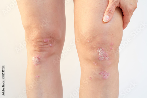 Psoriatic arthritis with skin psoriasis on a woman's knees. Inflammatory arthritis causing swelling, stiffness, redness, pain, and joint damage. Synovial fluid with psoriasis of the left knee.