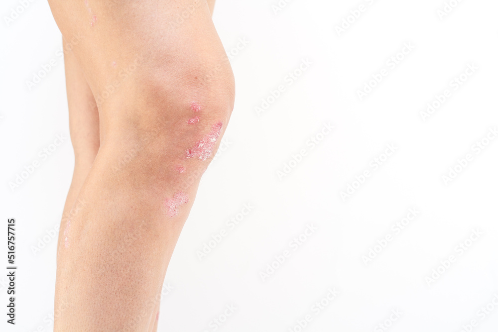 Psoriatic arthritis with skin psoriasis on a woman's knees