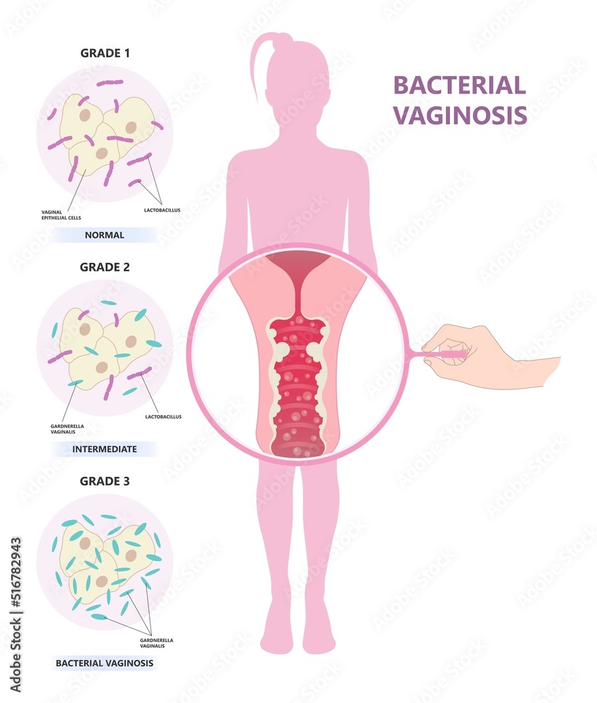 cervix yeast and Vagina bacterial sex odor fishy Foul smelling good ...