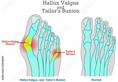 Tailor 's Bunion, hallux valgus anatomy. Foot bones, joint deformity feet. Top foot x ray, angle of  little pinky, big toe symptom structure. Orthopedic patients surgery. Illustration medical vector
