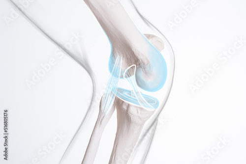 Knee ligament and meniscus, human leg, medically accurate representation of an arthritic knee joint