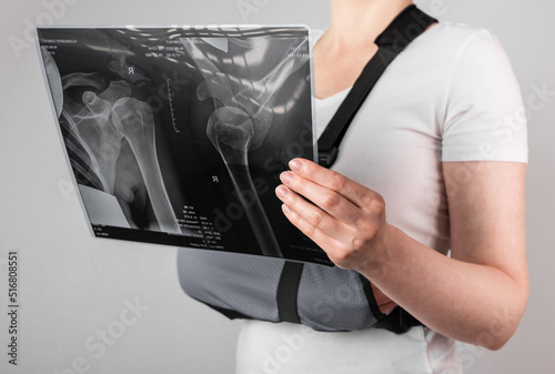 Woman wearing arm sling and looking at X-ray image. Female suffering from shoulder, clavicle, acromion fracture, strain. Health care, injury diagnostics concept. High quality photo photo