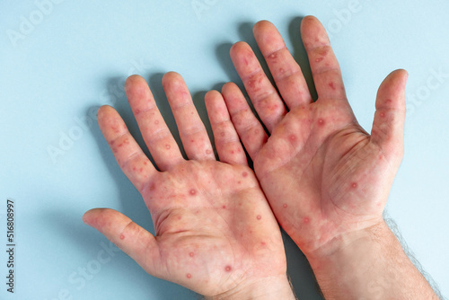 Obraz na plátně Male hands with Monkeypox rash