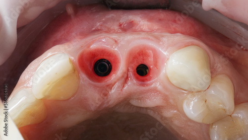 gingiva with two dental implants and a depressed gingiva for orthopedics