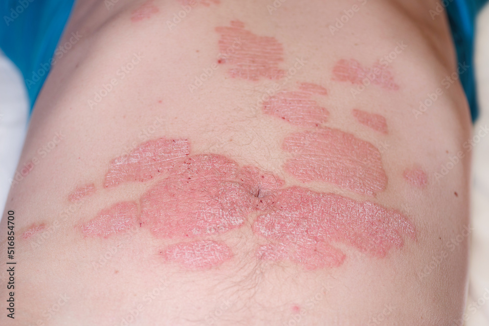 red-redness-spots-on-the-skin-large-red-inflamed-scaly-rash-on-the