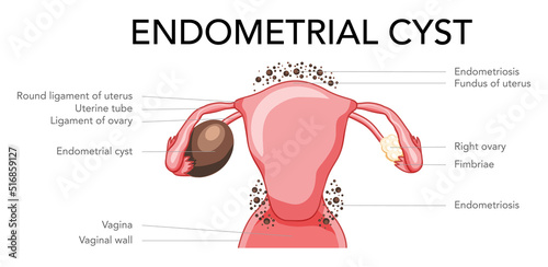Set of Ovarian endometriomas chocolate cysts Female reproductive system uterus problem diagram with inscriptions. Human medical anatomy internal organs flat style icon vector illustration isolated