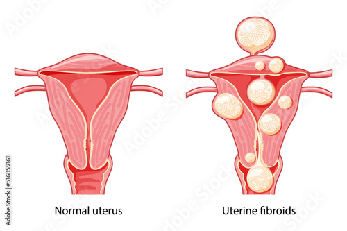 Set of Uterine fibroids Female leiomyomas reproductive system uterus normal and with disease pain. Human anatomy medical illustration isolated internal organs cervix, fallopian tube flat style icon