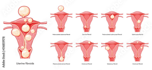 Set of Uterine fibroids Female leiomyomas reproductive system uterus. Front view in a cut. Human anatomy medical illustration isolated internal organs location scheme, cervix flat style icon