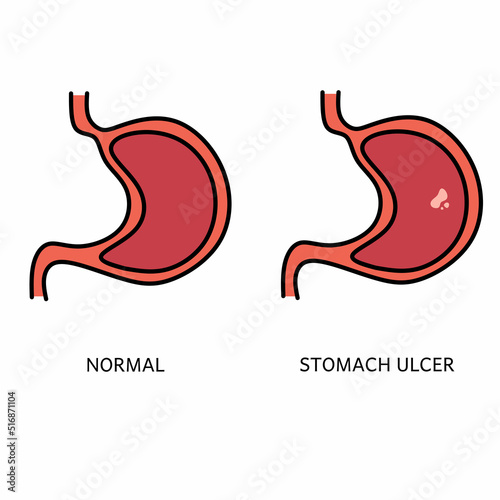 Vector illustration of peptic ulcer digestive disease poster. Infographic comparison of the anatomy of a normal stomach with peptic ulcers stomach. Digestive tract disorders. Health care and medical.