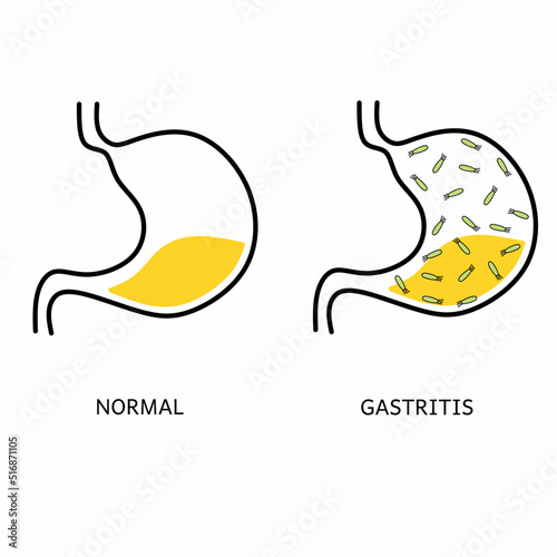 Vector illustration of gastritis digestive disease poster. Infographic comparison of the anatomy of a normal stomach with gastritis stomach. Digestive tract disorders. Health care and medical.