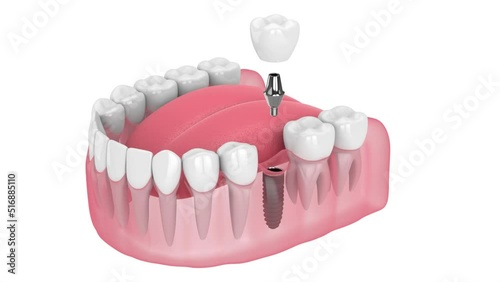 dental implant placement into lower jaw over white background photo