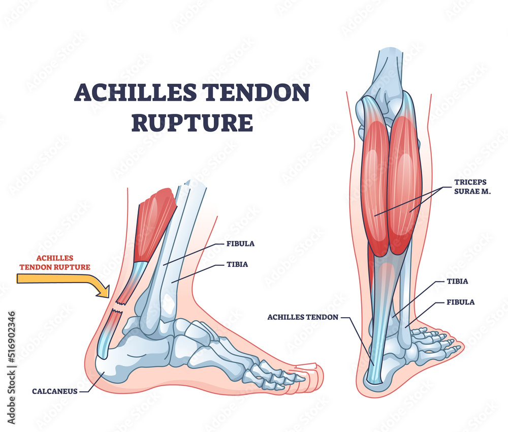 Achilles tendon rupture