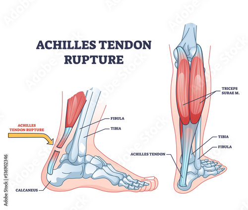 Achilles tendon rupture as painful injury and leg trauma outline diagram. Labeled educational anatomical scheme with orthopedic problem explanation vector illustration. Medical body muscle condition.