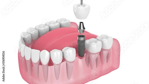 dental implant placement into lower jaw over white background photo