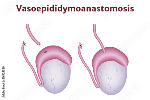 Reconstruction of the vas deferens. Vasovasoanastomosis. Anatomy of the male testicles. Medical poster. Vector illustration photo