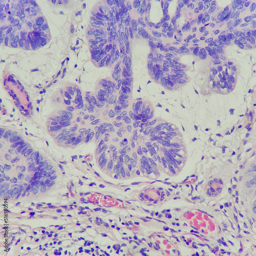 Camera photo of basal cell carcinoma of the skin tissue, showing tumor sheet with cleft artifact, magnification 400x, photograph through a microscope photo