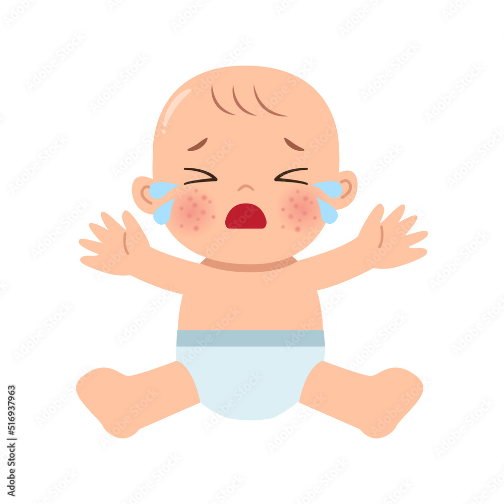 Baby having eczema skin problem on face. Flat vector cartoon design Baby having eczema skin problem on face. Flat vector cartoon design