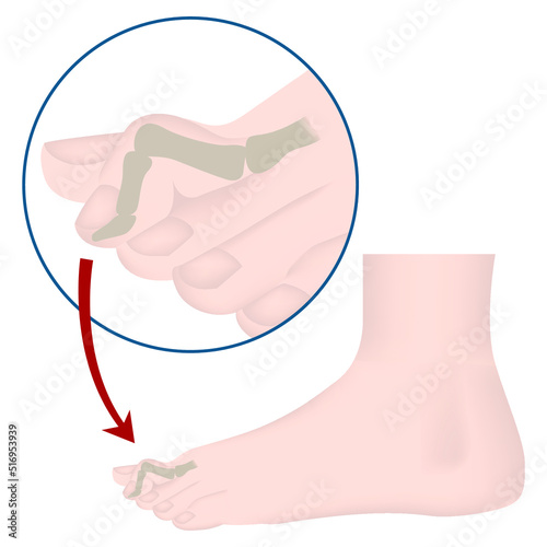 Hammer toe deformity. Medical poster. Vector illustration
