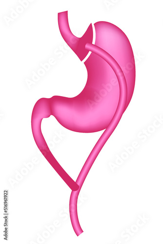 Gastric bypass. Treatment of obesity with surgery. Vector illustration