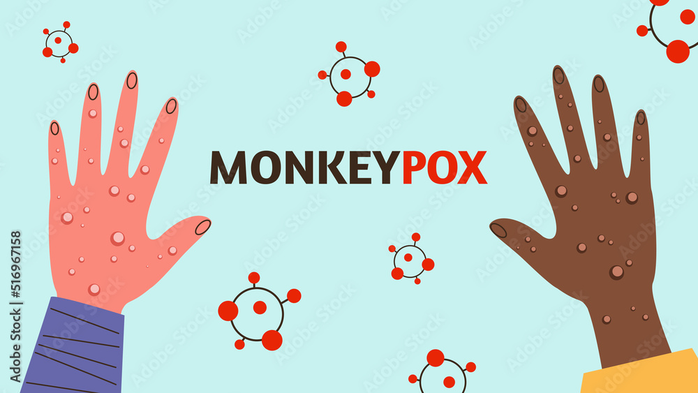 Monkeypox virus on human hands. Contagious disease awareness. Vector stock illustration.