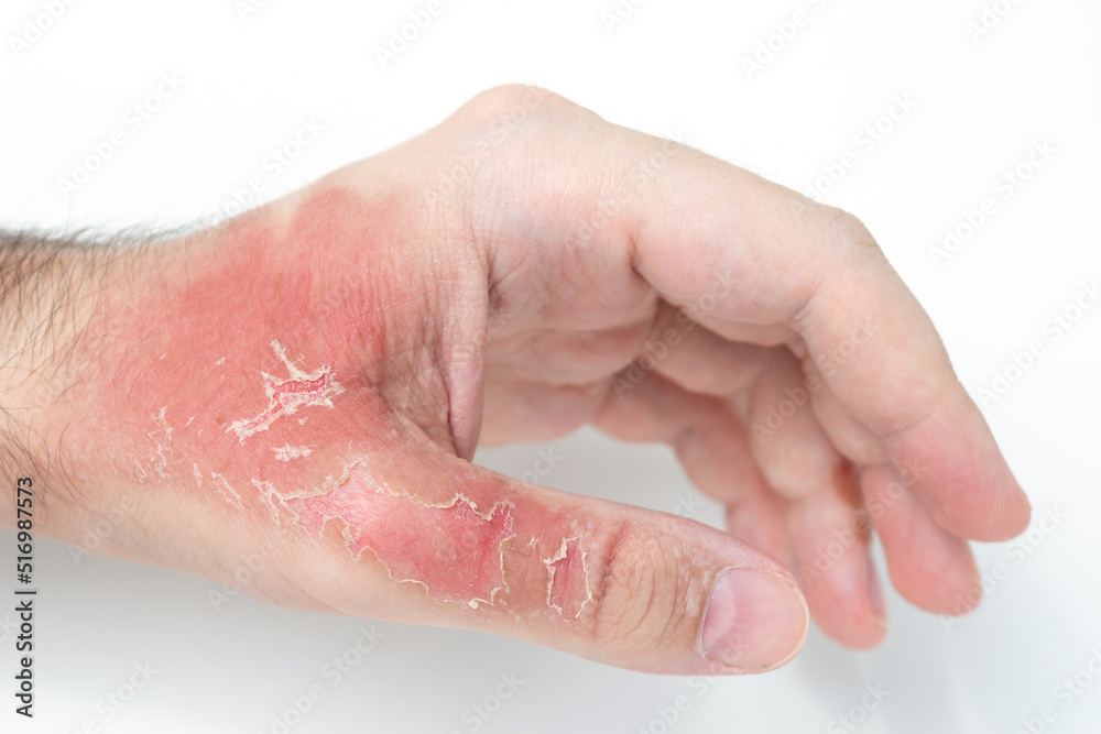 Fototapeta premium Man's hand with injuries and red dead skin on hand after thermal burn, domestic accident, careless behavior with boiling water on white background. Damage to hand after bursting glass with hot water.