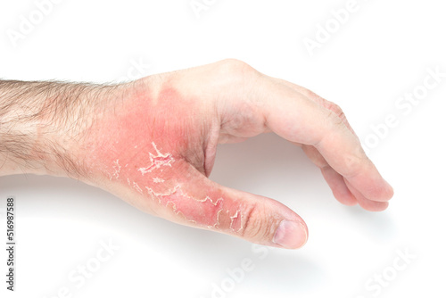 Man's hand with injuries and red dead skin on hand after thermal burn, domestic accident, careless behavior with boiling water on white background. Damage to hand after bursting glass with hot water.